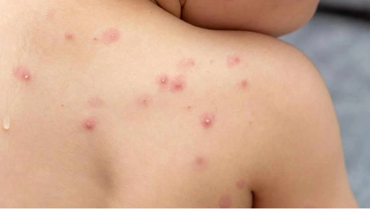 Çocuklarda sık görülen viral ateşli döküntülü hastalıklar